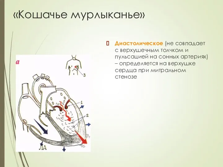 «Кошачье мурлыканье» Диастолическое (не совпадает с верхушечным толчком и пульсацией на сонных