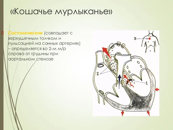 «Кошачье мурлыканье» Систолическое (совпадает с верхушечным толчком и пульсацией на сонных артериях)