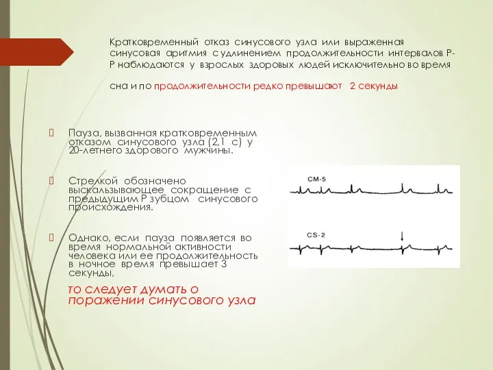 Кратковременный отказ синусового узла или выраженная синусовая аритмия с удлинением продолжительности интервалов