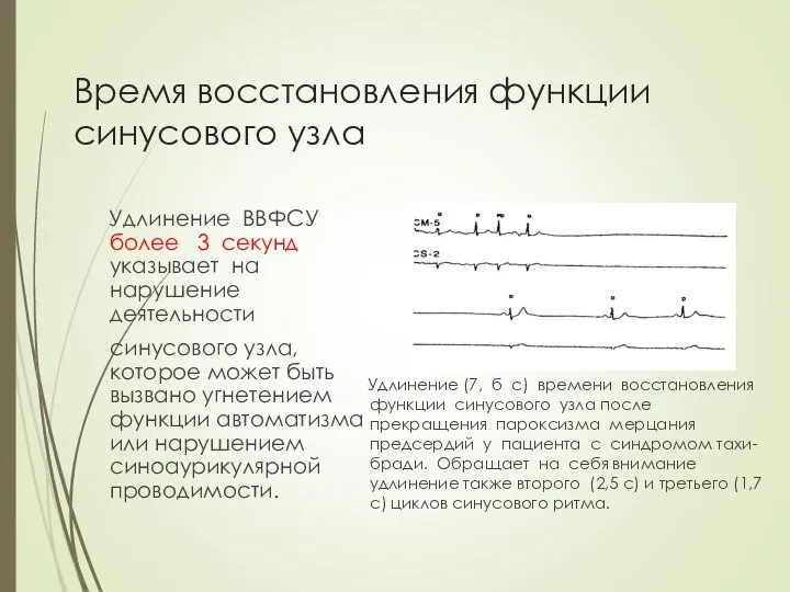 Время восстановления функции синусового узла Удлинение ВВФСУ более 3 секунд указывает на