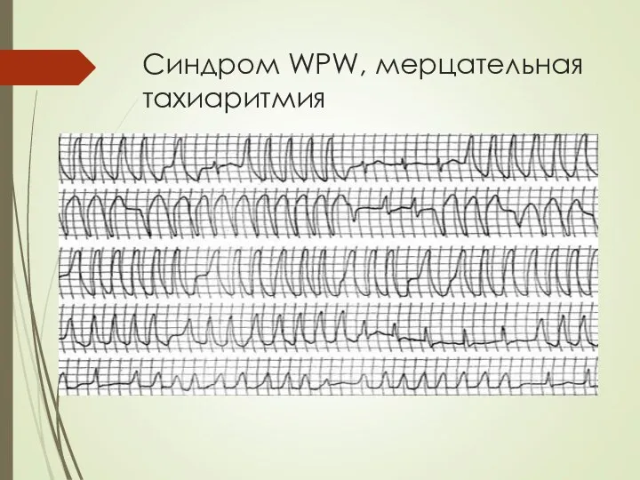 Синдром WPW, мерцательная тахиаритмия