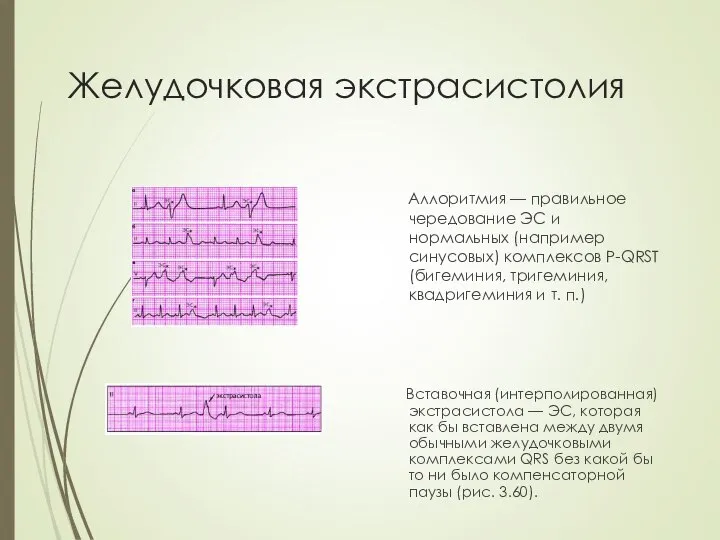 Желудочковая экстрасистолия Аллоритмия — правильное чередование ЭС и нормальных (например синусовых) комплексов