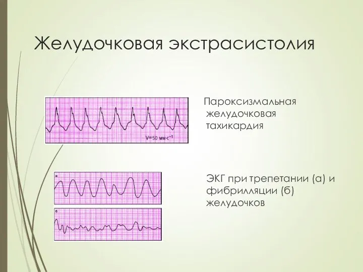 Желудочковая экстрасистолия Пароксизмальная желудочковая тахикардия ЭКГ при трепетании (а) и фибрилляции (б) желудочков