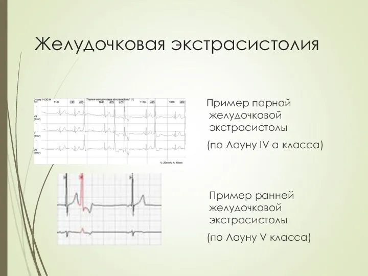 Желудочковая экстрасистолия Пример парной желудочковой экстрасистолы (по Лауну IV а класса) Пример