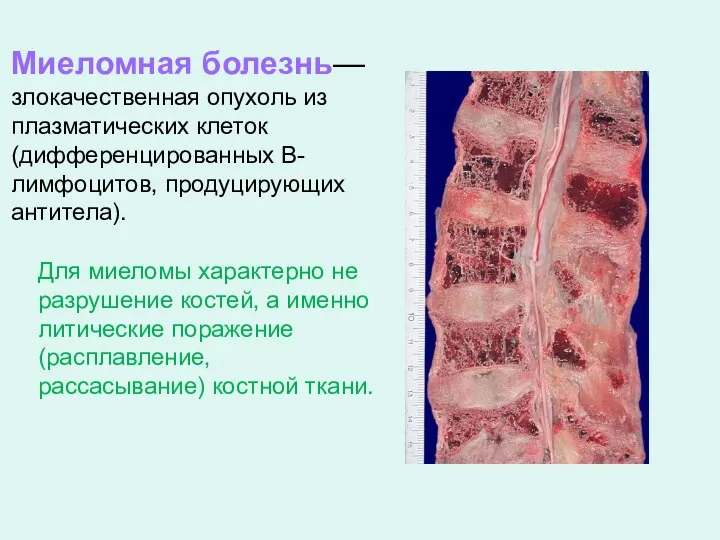 Миеломная болезнь— злокачественная опухоль из плазматических клеток (дифференцированных B-лимфоцитов, продуцирующих антитела). Для