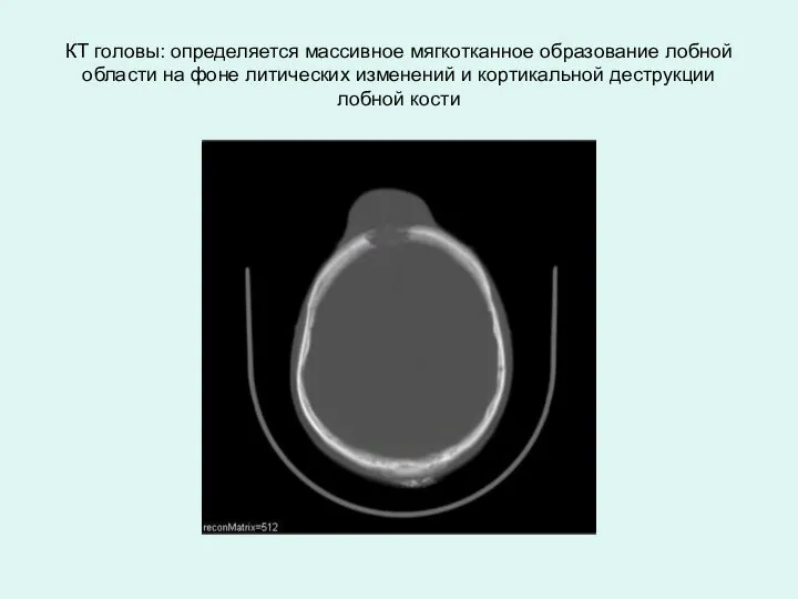 КТ головы: определяется массивное мягкотканное образование лобной области на фоне литических изменений