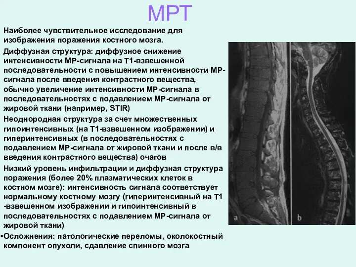 МРТ Наиболее чувствительное исследование для изображения поражения костного мозга. Диффузная структура: диффузное