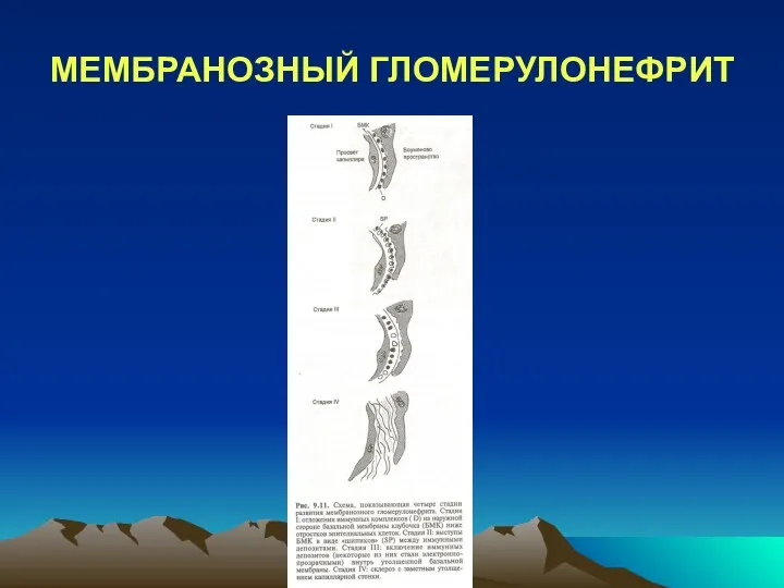 МЕМБРАНОЗНЫЙ ГЛОМЕРУЛОНЕФРИТ