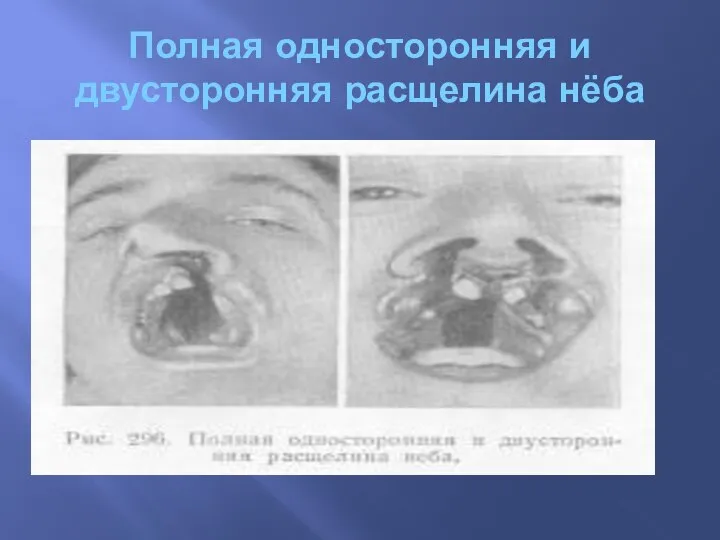 Полная односторонняя и двусторонняя расщелина нёба