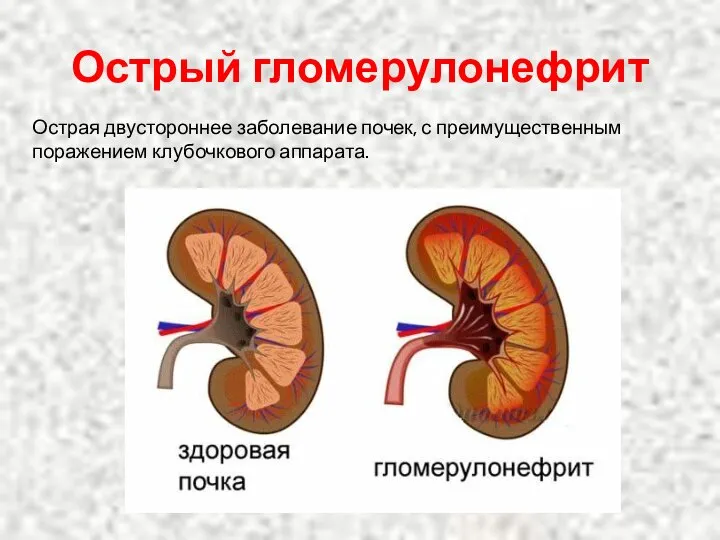 Острый гломерулонефрит Острая двустороннее заболевание почек, с преимущественным поражением клубочкового аппарата.