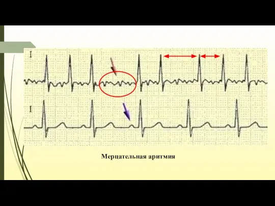 Мерцательная аритмия