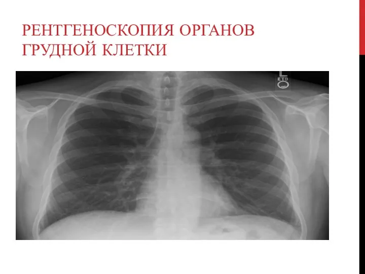 РЕНТГЕНОСКОПИЯ ОРГАНОВ ГРУДНОЙ КЛЕТКИ