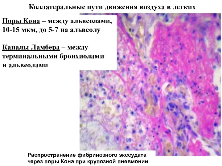 Коллатеральные пути движения воздуха в легких Поры Кона – между альвеолами, 10-15