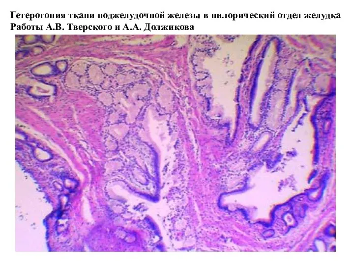 Гетеротопия ткани поджелудочной железы в пилорический отдел желудка Работы А.В. Тверского и А.А. Должикова