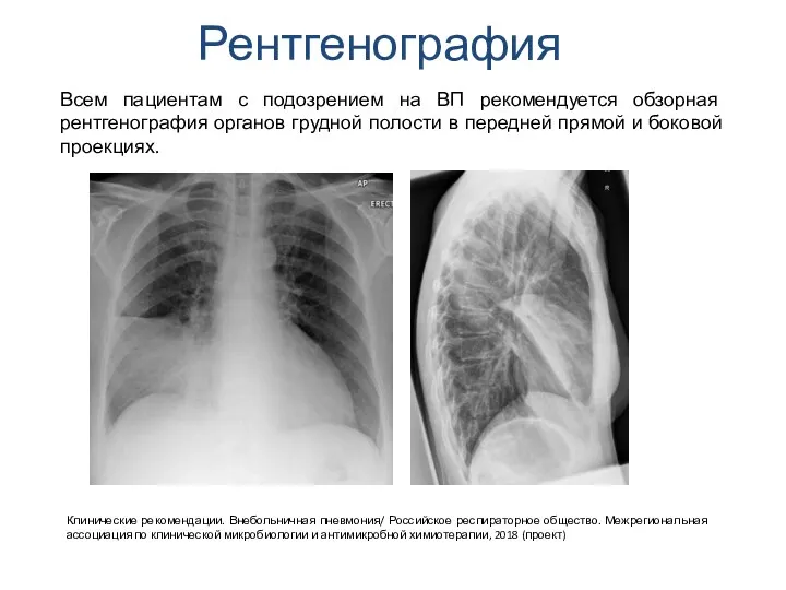 Рентгенография Всем пациентам с подозрением на ВП рекомендуется обзорная рентгенография органов грудной