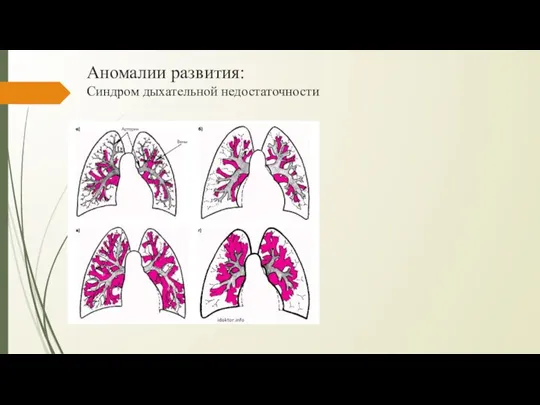 Аномалии развития: Синдром дыхательной недостаточности