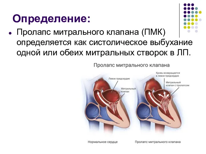 Определение: Пролапс митрального клапана (ПМК) определяется как систолическое выбухание одной или обеих митральных створок в ЛП.