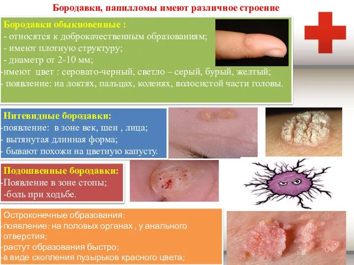 Бородавки, папилломы имеют различное строение Бородавки обыкновенные : - относятся к доброкачественным