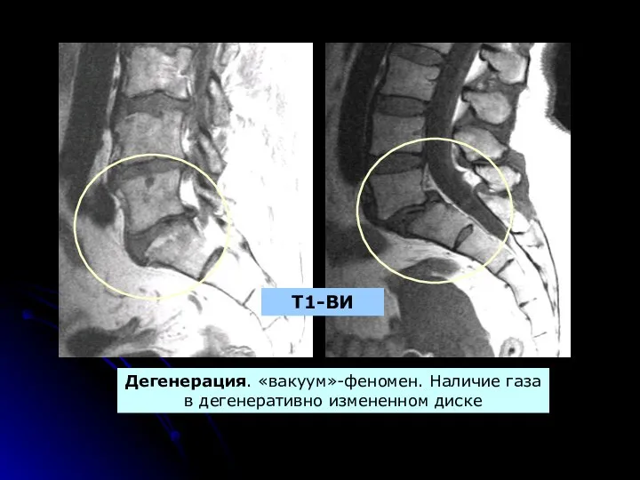 Дегенерация. «вакуум»-феномен. Наличие газа в дегенеративно измененном диске Т1-ВИ