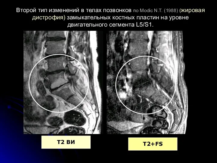 Второй тип изменений в телах позвонков по Modic N.T. (1988) (жировая дистрофия)