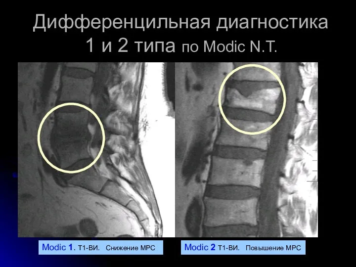 Дифференцильная диагностика 1 и 2 типа по Modic N.T. Modic 1. Т1-ВИ.