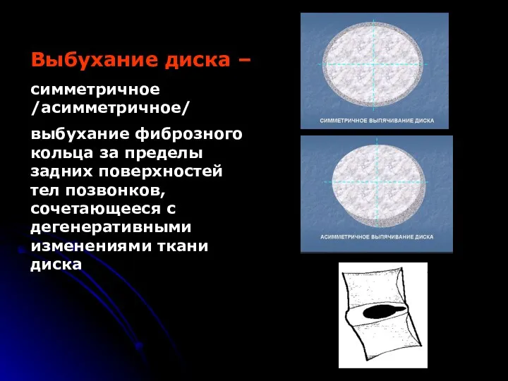 Выбухание диска – симметричное /асимметричное/ выбухание фиброзного кольца за пределы задних поверхностей