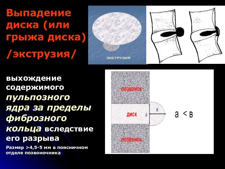 Выпадение диска (или грыжа диска) /экструзия/ выхождение содержимого пульпозного ядра за пределы