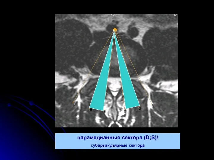 парамедианные сектора (D;S)/ субартикулярные сектора