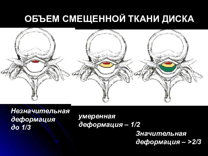 ОБЪЕМ СМЕЩЕННОЙ ТКАНИ ДИСКА Незначительная деформация до 1/3 умеренная деформация – 1/2 Значительная деформация – >2/3