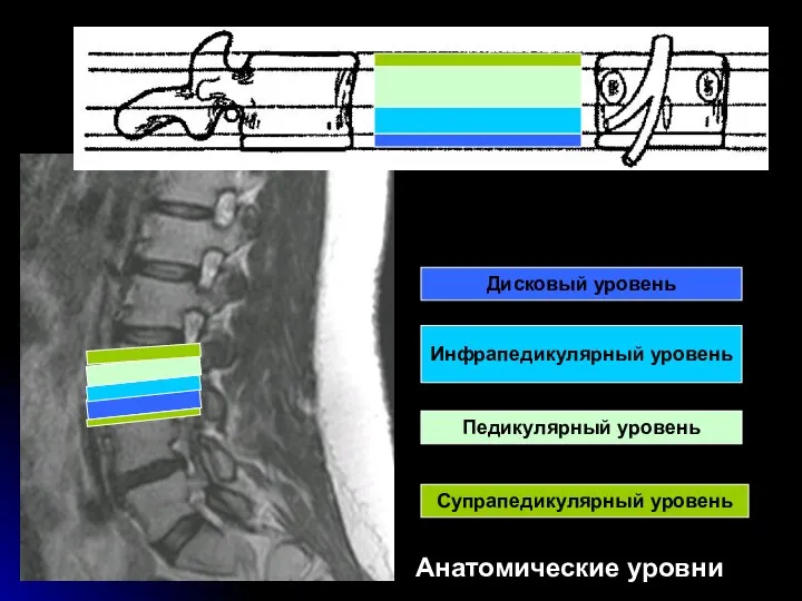 Дисковый уровень Инфрапедикулярный уровень Педикулярный уровень Супрапедикулярный уровень Анатомические уровни