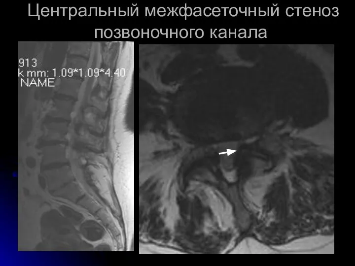 Центральный межфасеточный стеноз позвоночного канала