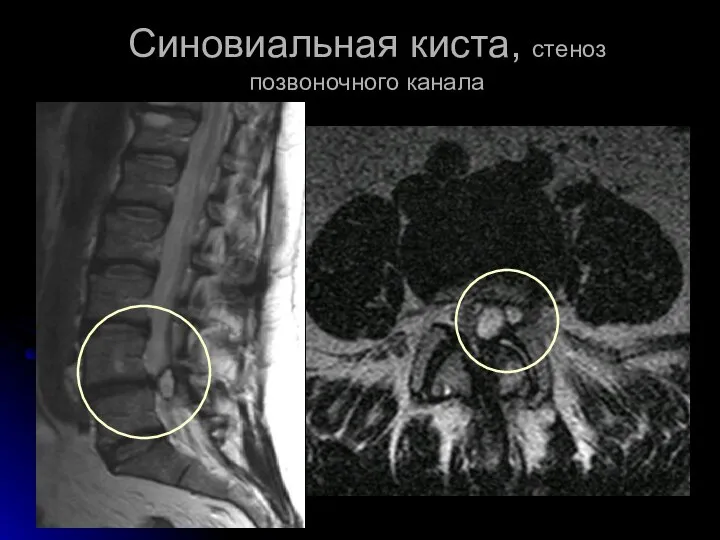 Синовиальная киста, стеноз позвоночного канала