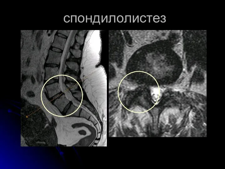 спондилолистез