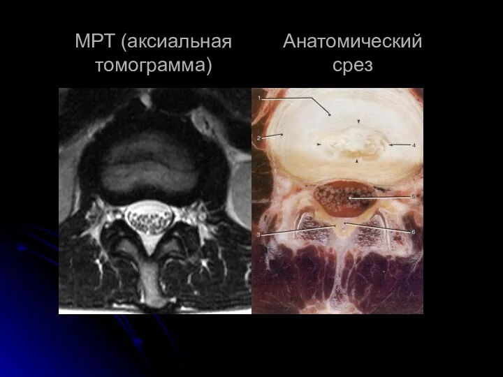 МРТ (аксиальная томограмма) Анатомический срез