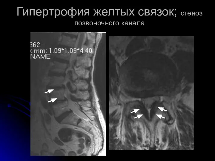 Гипертрофия желтых связок; стеноз позвоночного канала