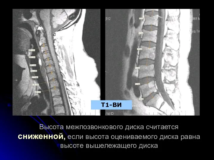 Высота межпозвонкового диска считается сниженной, если высота оцениваемого диска равна высоте вышележащего диска Т1-ВИ