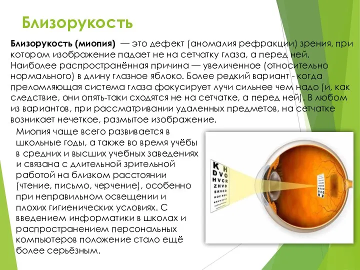 Близорукость Близорукость (миопия) — это дефект (аномалия рефракции) зрения, при котором изображение