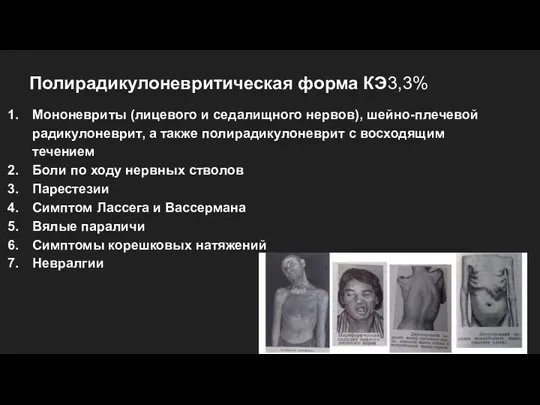 Полирадикулоневритическая форма КЭ3,3% Мононевриты (лицевого и седалищного нервов), шейно-плечевой радикулоневрит, а также