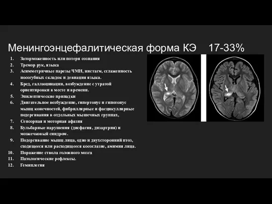 Менингоэнцефалитическая форма КЭ 17-33% Заторможенность или потеря сознания Тремор рук, языка Асимметричные