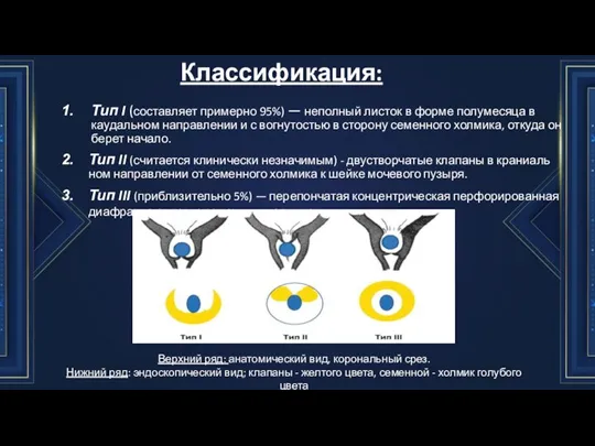 Классификация: Тип I (со­ставляет примерно 95%) — неполный листок в форме полумесяца