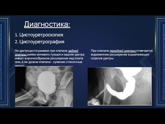 Диа­гностика: 1. Цистоуретроскопия 2. Цистоуретрография На уретроцистограммах при клапане задней уретры шейка