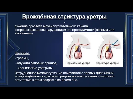 Врождённая стриктура уретры - сужение просвета мочеиспускательного канала, сопровождающееся нарушением его проходимости