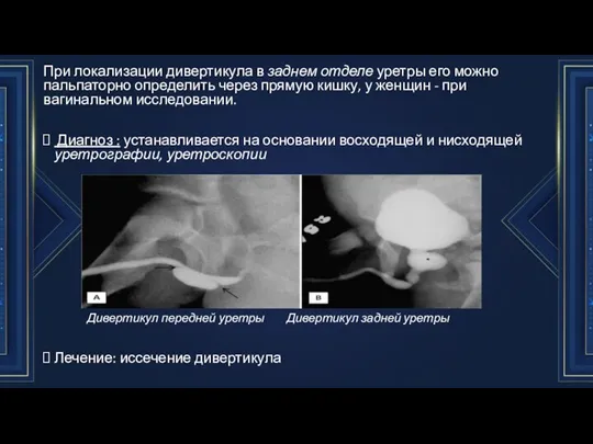 При локализации дивертикула в заднем отделе уретры его можно пальпаторно определить через