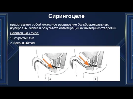 Сирингоцеле представляет собой кистозное расширение бульбоуретральных (куперовых) желёз в результате облитерации их