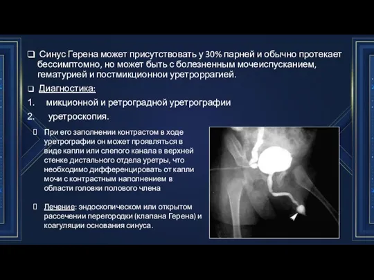 Синус Герена может присутствовать у 30% парней и обычно протекает бессимптомно, но