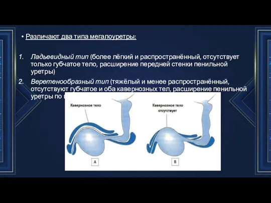 Различают два типа мегалоуретры: Ладьевидный тип (более лёгкий и распространённый, отсутствует только