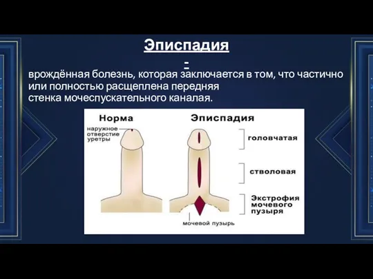 Эписпадия - врождённая болезнь, которая заключается в том, что частично или полностью