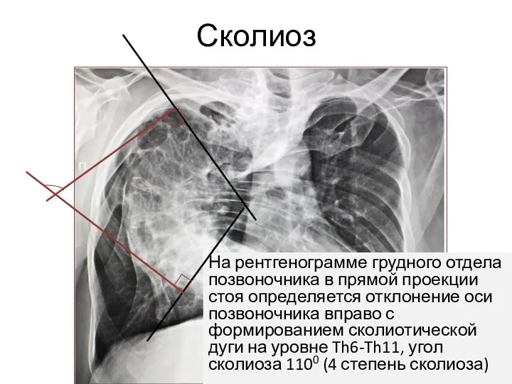 Сколиоз На рентгенограмме грудного отдела позвоночника в прямой проекции стоя определяется отклонение