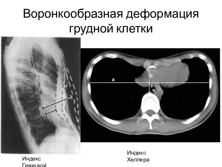 Воронкообразная деформация грудной клетки Индекс Гижицкой Индекс Хеллера