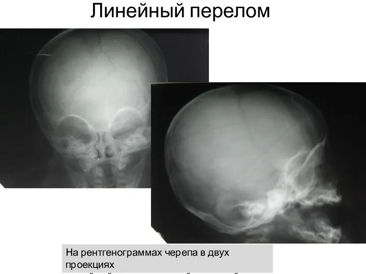 Линейный перелом На рентгенограммах черепа в двух проекциях линейный перелом правой теменной кости
